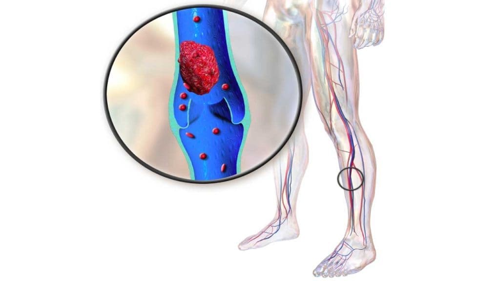 Deep vein thrombosis, a common precursor of pulmonary embolism