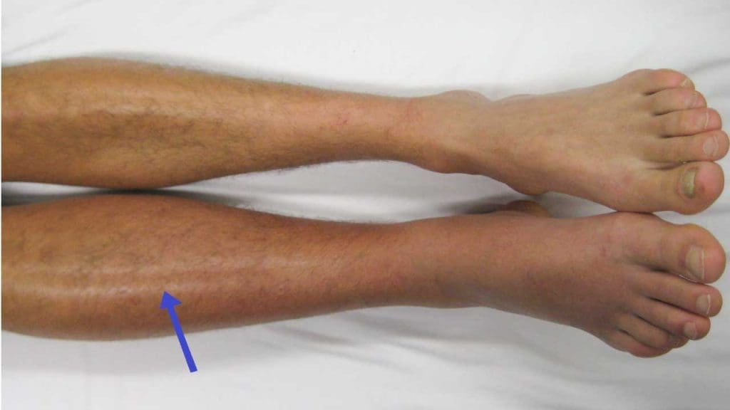 Deep vein thrombosis (DVT) in the right leg causing swelling and redness compared to the left leg. 