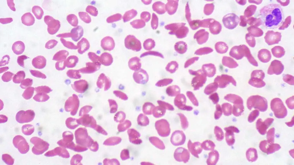 Microscopic view of SCD: Anisopoikilocytosis and characteristic sickled erythrocytes in a peripheral blood smear.