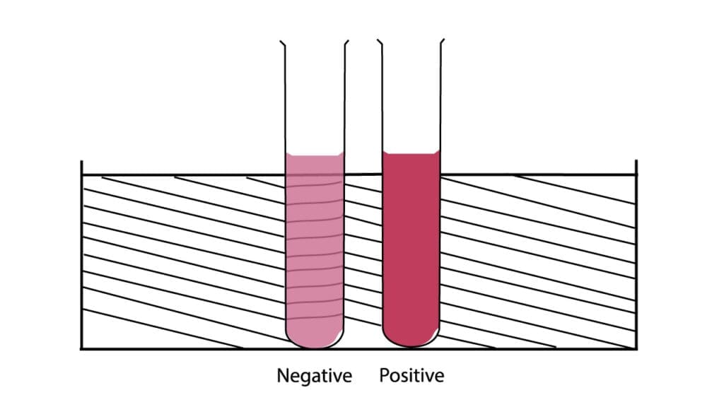 The illustration indicates the negative result test tube on the left which displays a clear, transparent solution, while the positive test tube on the right shows distinct turbidity, indicating the presence of Hemoglobin S (HbS) in the macroscopic solubility appearance of sickle cell disease test (dithionite solubility test).