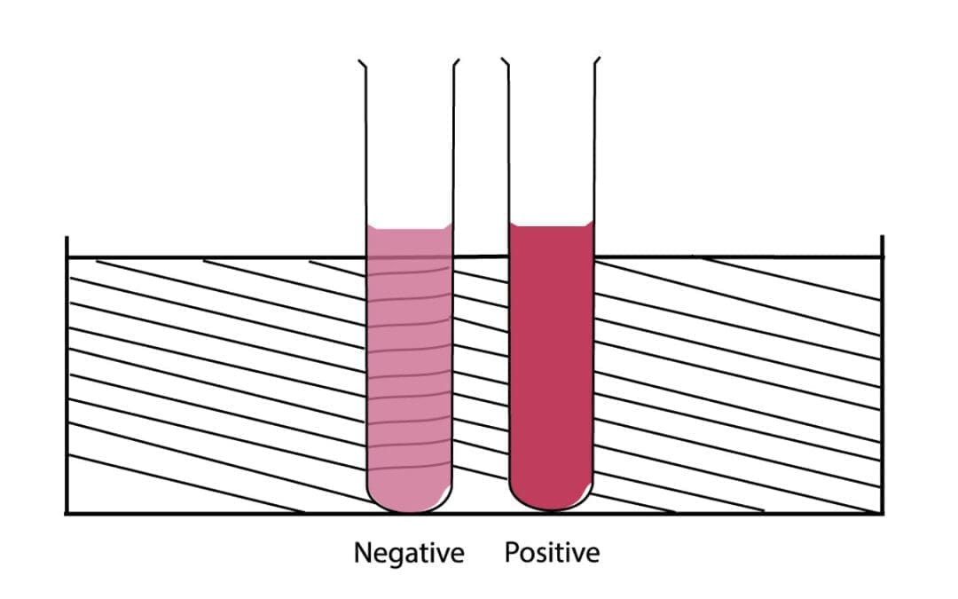 Sickle Cell Disease Test