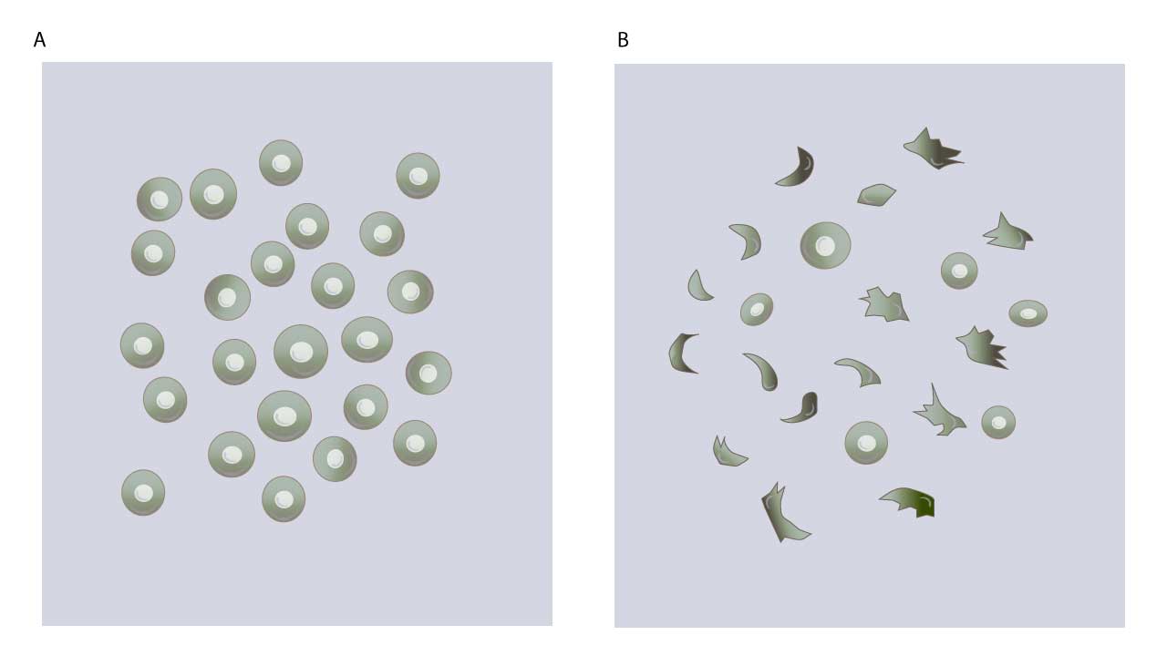 Panel A reveals healthy red blood cells, while Panel B showcases the abnormal cell shapes associated with sickle cell disease in a sickling test.