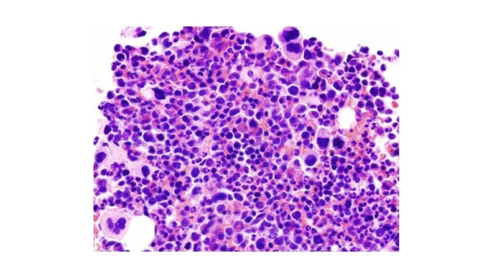 Microscopic image of bone marrow showing abnormal large megakaryocytes with multi-lobed nuclei.