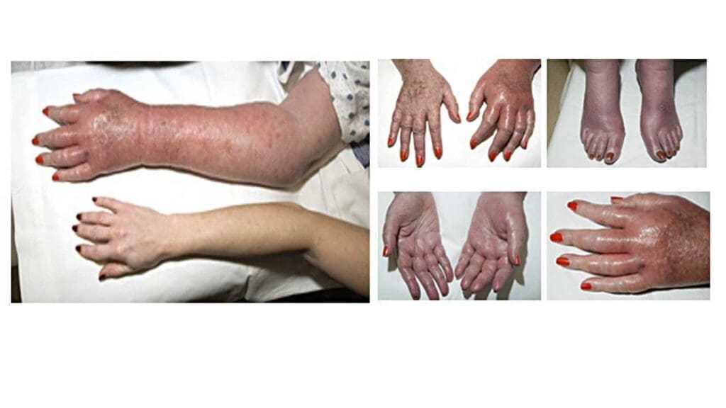 Erythromelalgia in the extremities of a patient with polycythemia vera, leaving her with bouts of redness, swelling and burning pain in the affected sites. 