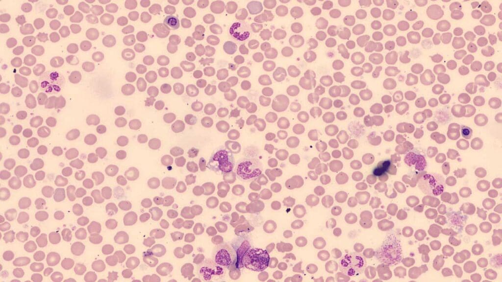 Peripheral blood smear characteristic of primary myelofibrosis, demonstrating teardrop red blood cells, leukoerythroblastic picture, and anisopoikilocytosis.