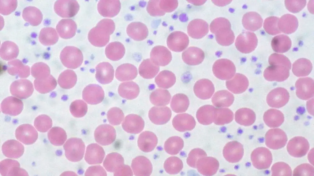 Elevated platelet count with presence of giant platelets in essential thrombocythemia