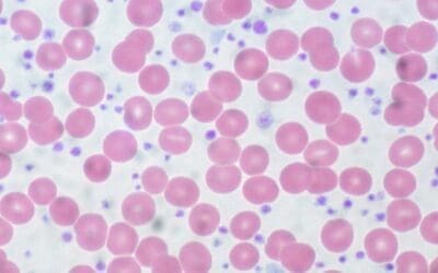 Essential Thrombocythemia (ET): High Platelet