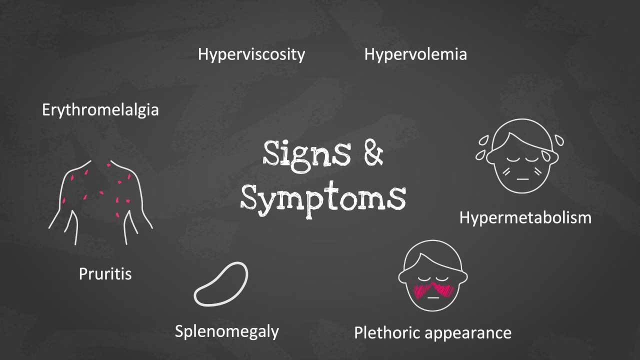 A schematic diagram displaying various symptoms of polycythemia vera (PV). The diagram branches out from a central point labeled "Signs and symptoms" with arrows connecting it to seven surrounding boxes. Each box contains a symptom: hyperviscosity, hypervolemia, hypermetabolism, ph plethora, splenomegaly, pruritus, and erythromelalgia.
