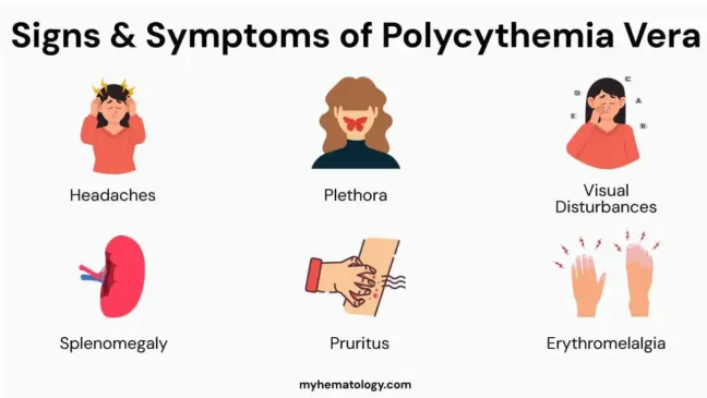 Vera Sign Polycythemia Vera: Causes, Pathophysiology, Symptoms & Treatment