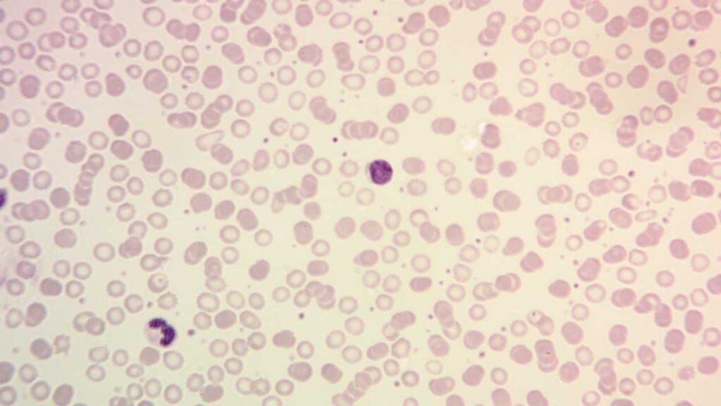 Hematopathology at work: Close-up image of a peripheral blood smear showing thrombocytosis. Numerous red blood cells are visible, along with an abnormally high number of platelets, appearing as small purple dots of various sizes and shapes, distributed throughout the smear. This increased platelet count is characteristic of thrombocytosis, a medical condition where the body produces too many platelets.