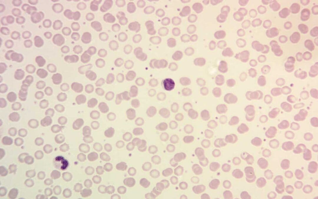 Hematopathology: Unveiling the Mysteries of Blood and Beyond