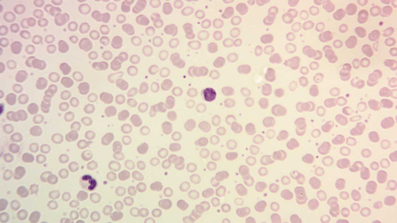 Close-up image of a peripheral blood smear showing thrombocytosis. Numerous red blood cells are visible, along with an abnormally high number of platelets, appearing as small purple dots of various sizes and shapes, distributed throughout the smear. This increased platelet count is characteristic of thrombocytosis, a medical condition where the body produces too many platelets.