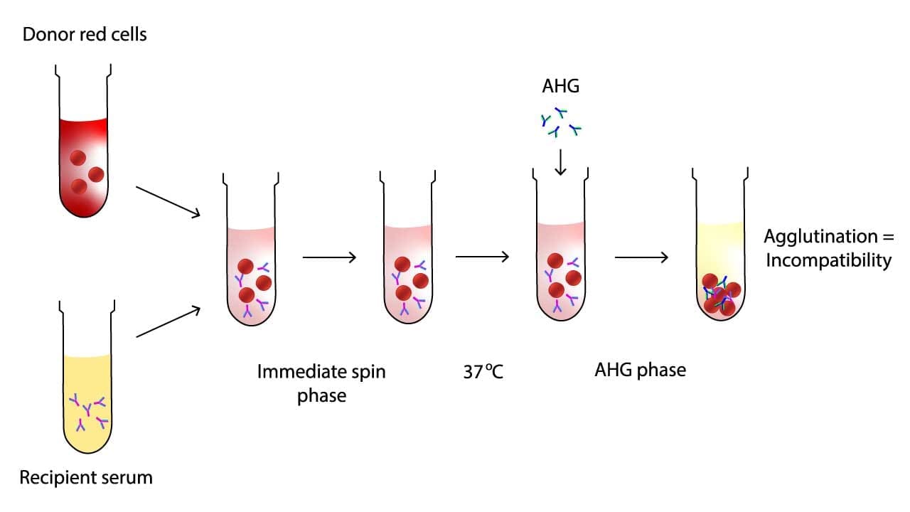 The serological crossmatch acts as the final guardian of transfusion safety. It verifies ABO compatibility and hunts for hidden dangers like antibodies that might've slipped past initial screening. It mixes recipient serum with donor red blood cells, checking for immediate reactions like clumping (agglutination) or breakdown (hemolysis). If these occur, it indicates an incompatible match, prompting further investigation. Conversely, no agglutination in a patient with a negative antibody screen signifies a compatible match, greenlighting the transfusion.