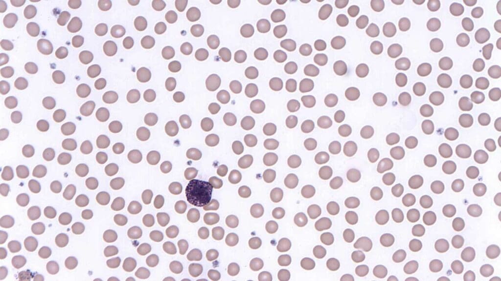 A basophil found in the peripheral blood smear with large deep bluish-purplish cytoplasmic granules which obscure the nucleus. 