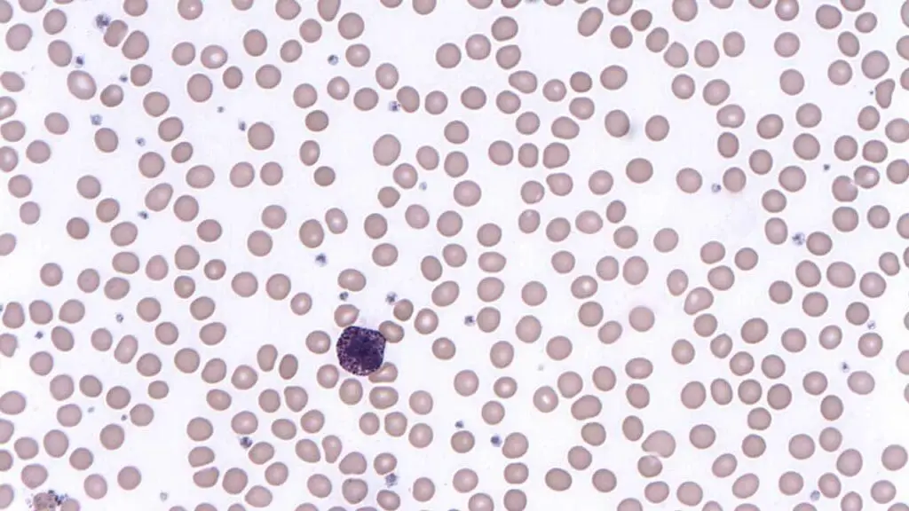 A basophil found in the peripheral blood smear. Basophils have large deep bluish-purplish cytoplasmic granules which obscure the nucleus. 