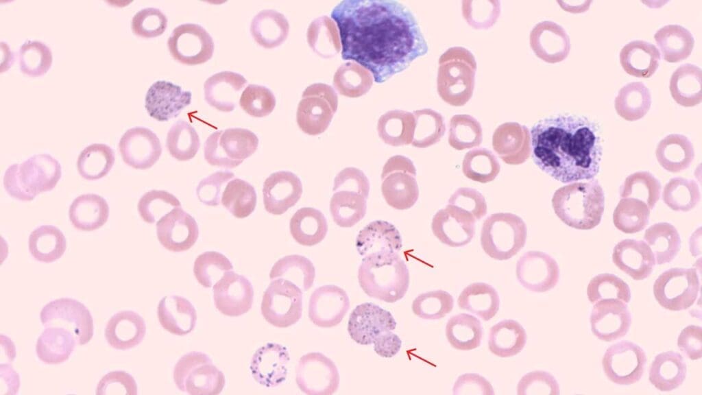 Basophilic stippling inclusion bodies are ribosomal aggregates in the red blood cells.