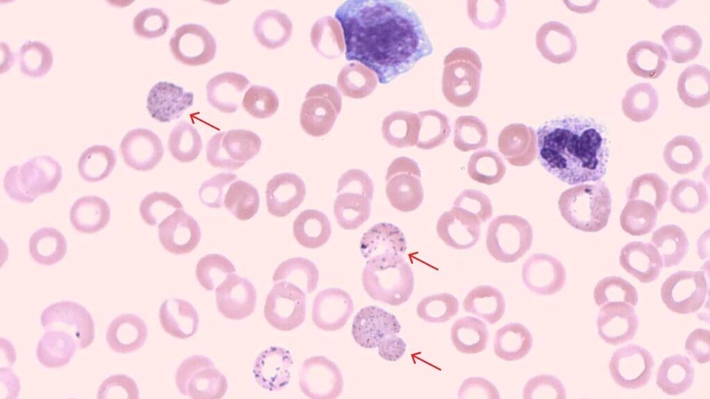 Red Blood Cell (RBC) Inclusion Bodies: Types and Causes