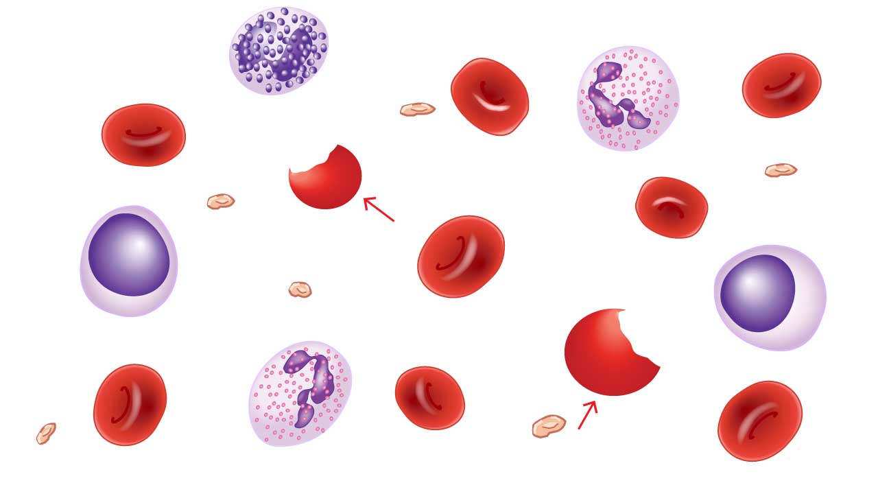 Diagram of various blood cells, including several red blood cells with crescent-shaped indentations on their sides, resembling bites taken out of a cookie. These are bite cells (schistocytes) and can indicate mechanical damage to red blood cells. The text describes their association with G6PD deficiency, where damaged cell components are removed by macrophages, leaving the characteristic bite-like shape.
