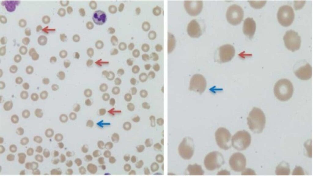 Blister cells are indicated by the red arrows while the blue arrows indicate a bite cells.