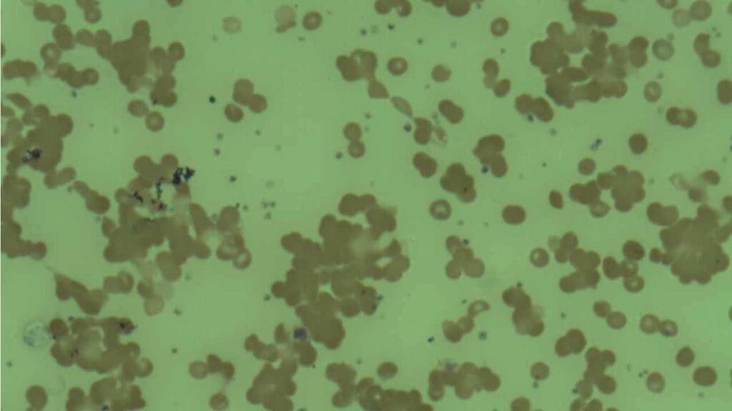 Red cell agglutination in a peripheral blood smear of a patient with CAD