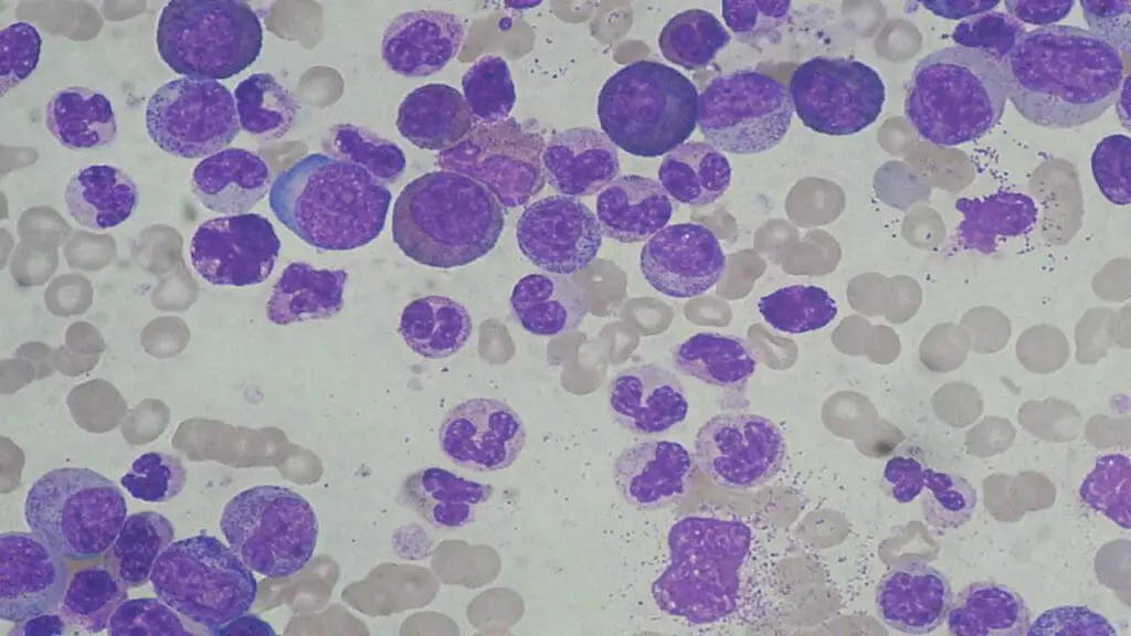 Marked leucocytosis with granulocyte left shift. 