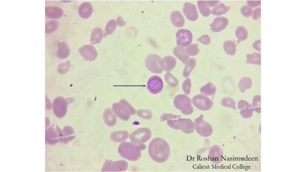 Cabot rings are delicate, threadlike inclusions that look like rings or figure-eights inside red blood cells seen in this image with basophilic stippling.