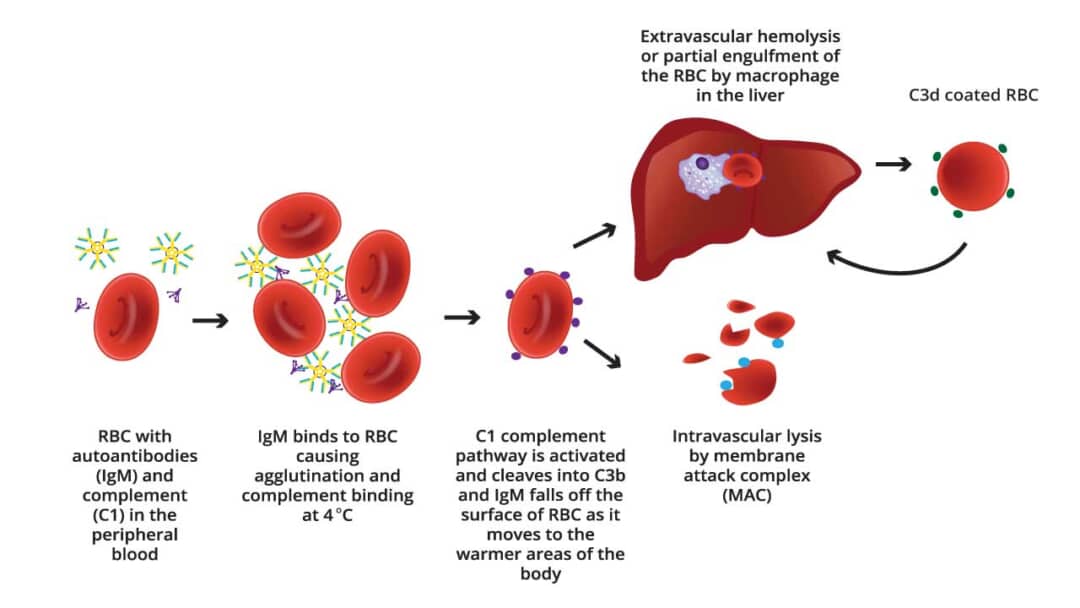 Autoimmune Hemolytic Anemia (AIHA): Warm AIHA & CAD