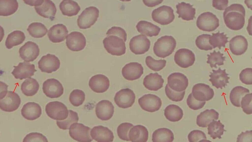 Echinocytes (Burr or crenated red cells) have numerous small evenly spaced spikes 