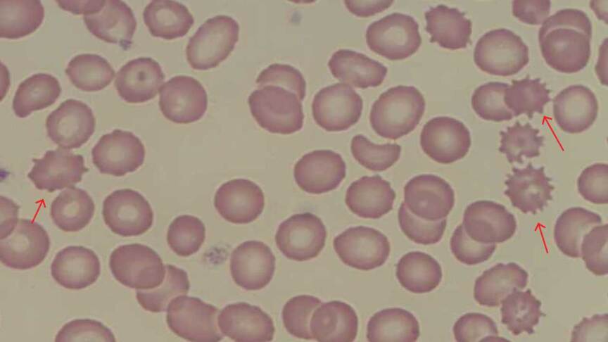 Mild Crenation Rbc Abnormal Red Blood Cell Morphology: Causes & Interpretation