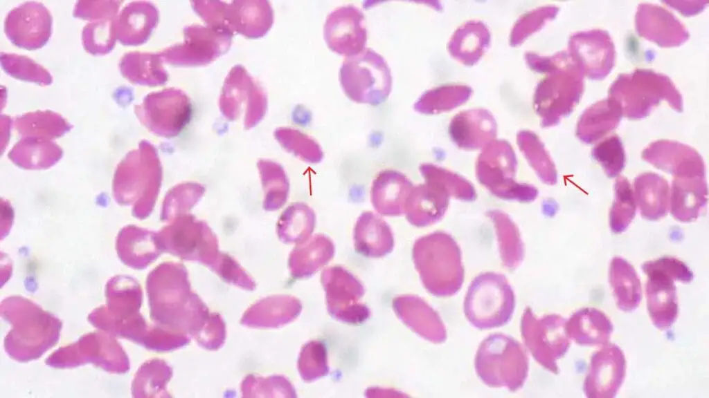 Elliptocytes are elongated red cells resembling an oval shape on the peripheral blood smear