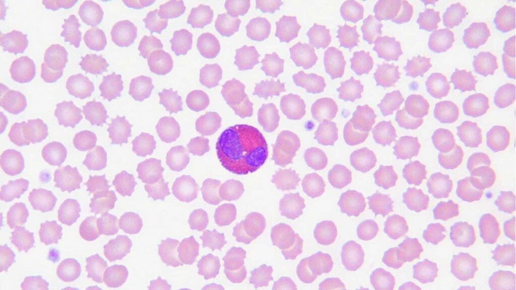 Eosinophils in the center of the peripheral blood film showing its purplish bilobed nucleus surrounded by numerous red-orange granules. 