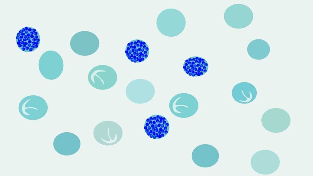 Microscopic image of a peripheral blood smear stained with Brilliant Cresyl Blue (BCB). Numerous red blood cells contain round, blue-purple inclusions, characteristic of Hb H disease. These inclusions are composed of excess beta-globin protein.