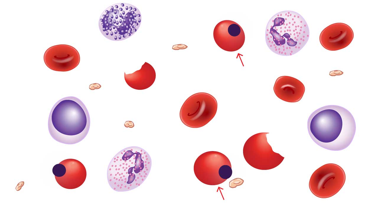 Heinz bodies are telltale signs of damage within red blood cells. These inclusion bodies appear as clumps of denatured hemoglobin, the oxygen-carrying protein. They arise due to oxidative stress or certain medications, and while not directly causing symptoms, indicate potential damage that can contribute to anemia.