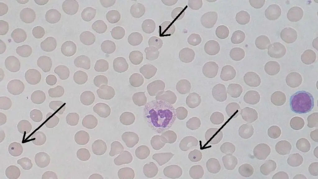 Howell-Jolly inclusion bodies in the red cells pointing to a potential problem in the spleen. 