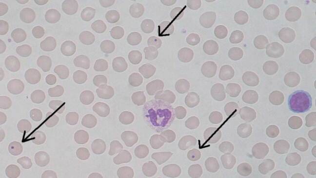 Examples Of Cell Inclusions Red Blood Cell (RBC) Inclusion Bodies: Types and Causes