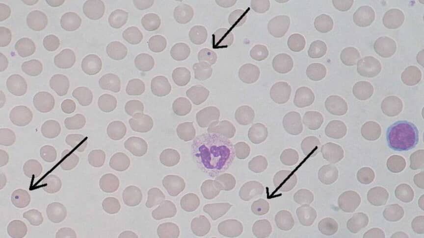 Red Blood Cell (RBC) Inclusion Bodies: Types and Causes