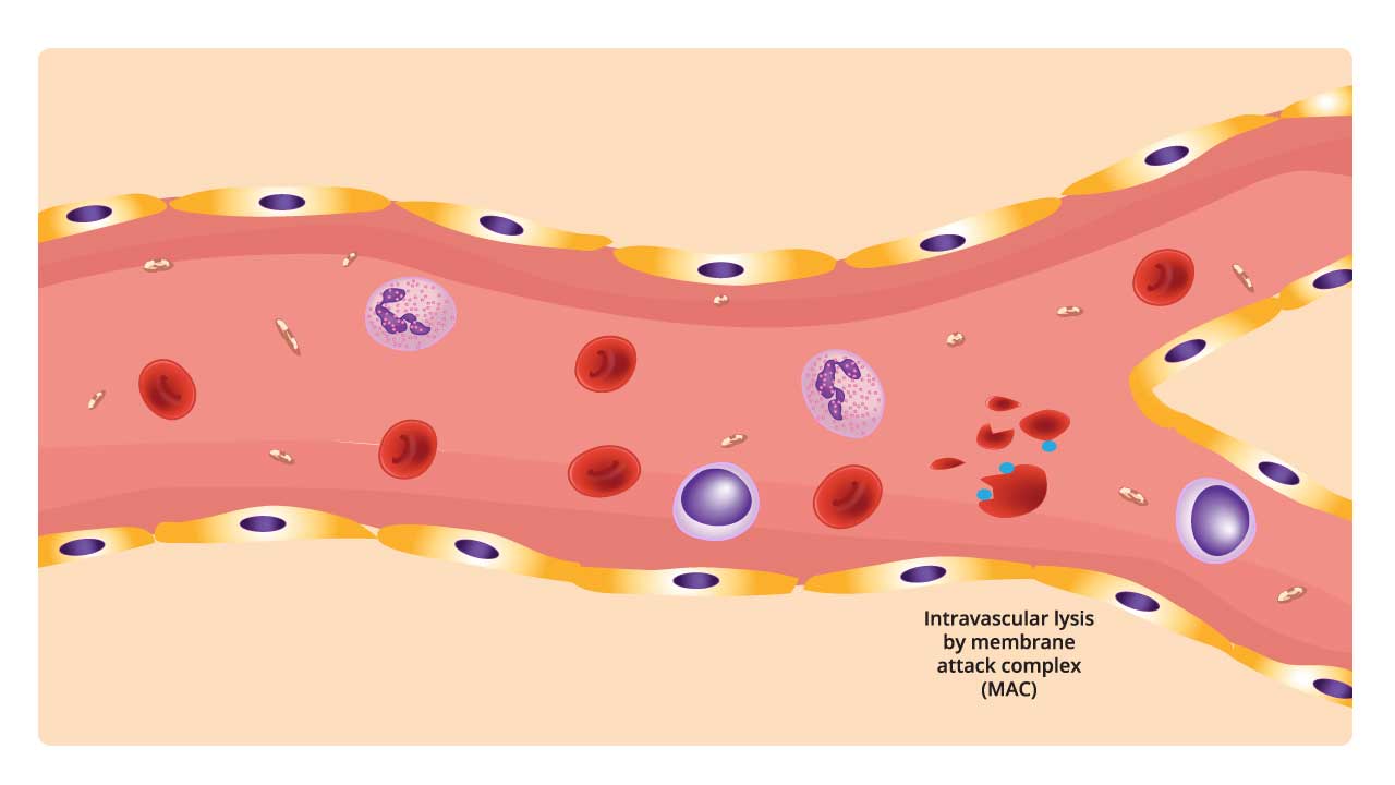 Diagram of intravascular hemolysis. A red blood cell is being lysed (broken apart) by round-shaped structures called the membrane attack complex (MAC) within a blood vessel. MAC is formed by immune system proteins and disrupts the red blood cell membrane, causing it to burst. This process can occur when antibodies or other proteins attach to the red blood cell surface, contributing to hemolytic anemia