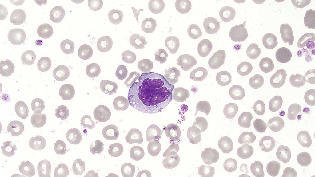 Monocyte in a peripheral blood smear with the characteristic U- or kidney-shaped nucleus