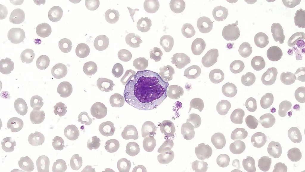 Monocyte in a peripheral blood smear with the characteristic U- or kidney-shaped nucleus