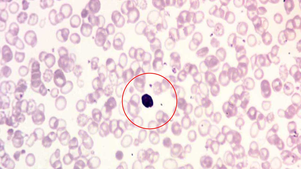 This blood smear image showcases the hallmarks of severe anemia. The large, centrally nucleated red blood cell (NRBC) indicates the bone marrow is releasing immature cells in an attempt to compensate for a lack of healthy red blood cells. The surrounding red cells are severely hypochromic (pale due to low hemoglobin) and microcytic (smaller than normal), further highlighting the anemia. Additionally, the variation in size and shape of these red blood cells (anisocytosis and poikilocytosis) is collectively termed anisopoikilocytosis, signifying underlying issues in red blood cell production or maturation.