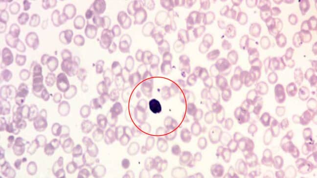 Red Blood Cell (RBC) Inclusion Bodies: Types and Causes