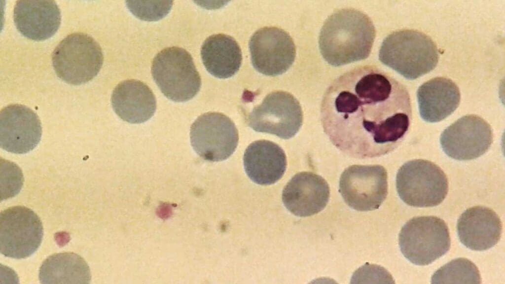 Neutrophil in the peripheral blood smear with 2 - 5 lobed nucleus and pinkish fine granules in the cytoplasm. 