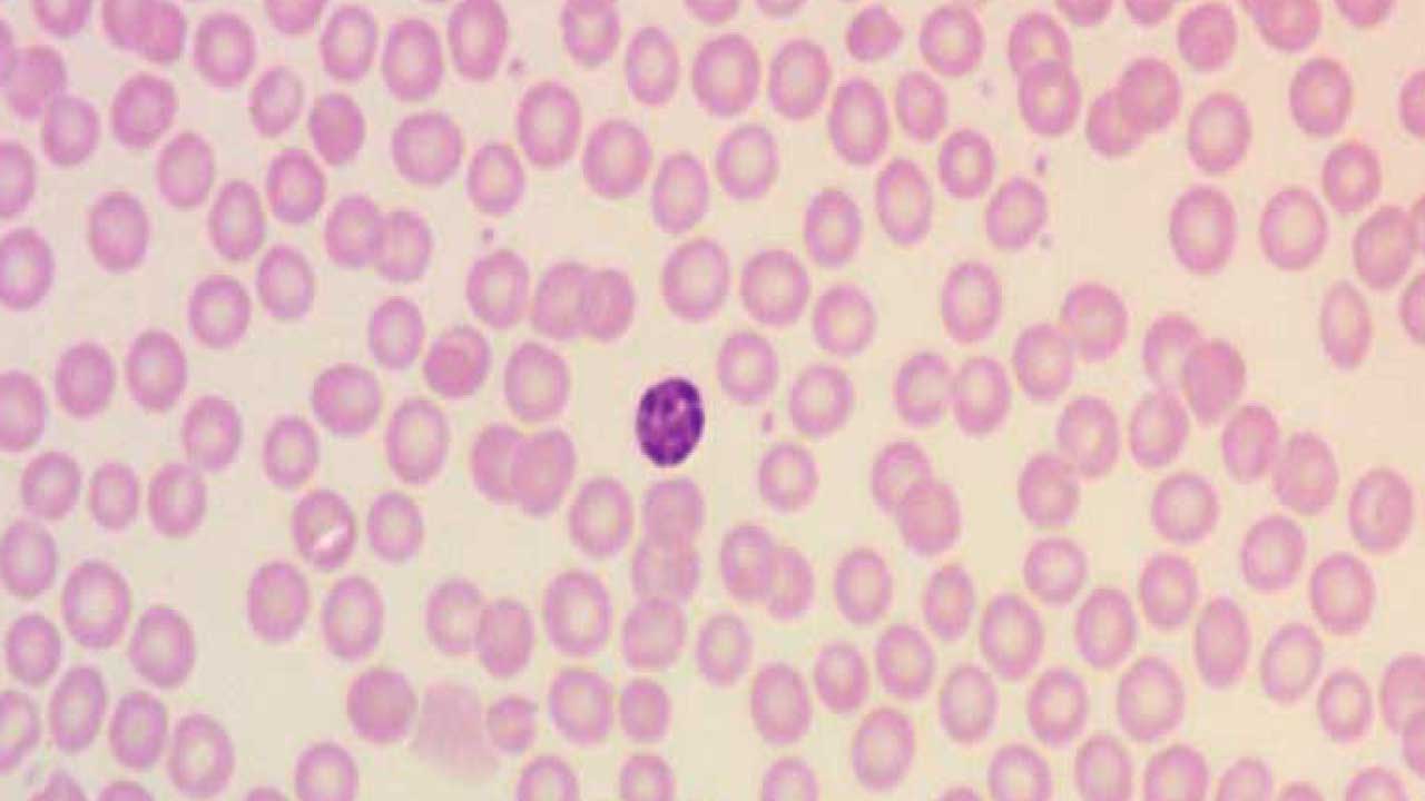  Diagram of a normal red blood cell (RBC) with a central pallor area representing about one-third of the cell's diameter. This pallor is due to the biconcave disc shape of healthy RBCs. A small lymphocyte is included for size comparison.