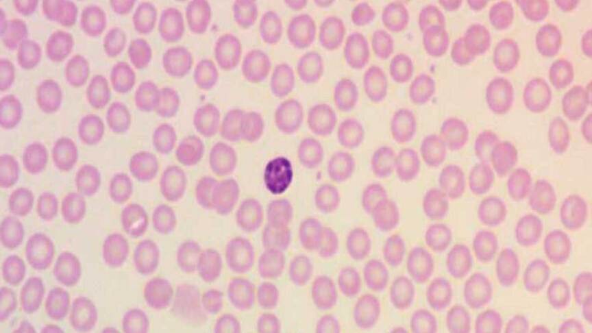 Abnormal Rbc Gif Abnormal Red Blood Cell Morphology: Causes & Interpretation