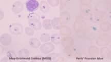 Red Blood Cell (RBC) Inclusion Bodies: Types and Causes
