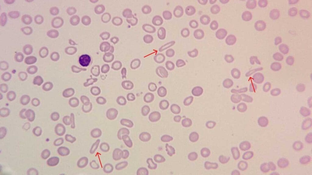 A blood smear containing several elongated, pencil-shaped red blood cells  alongside anisopoikilocytic red cells. These pencil shaped cells are a characteristic finding in iron deficiency anemia.