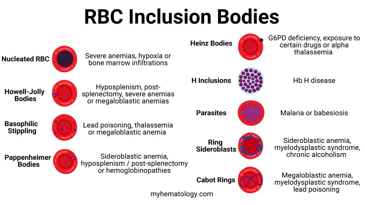 Red blood cell inclusion bodies are abnormal aggregates of material within the cytoplasm of red blood cells, which are visible under a microscope and are indicative of various underlying diseases or conditions.
