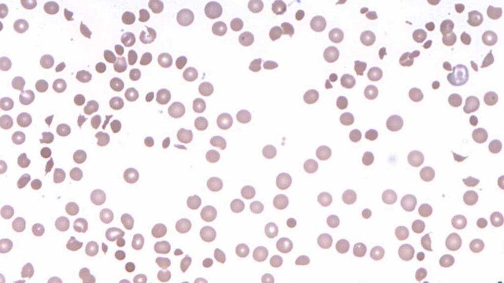 Spherocytes, fragmented RBCS and polychromasia in a peripheral blood smear indicating hemolysis