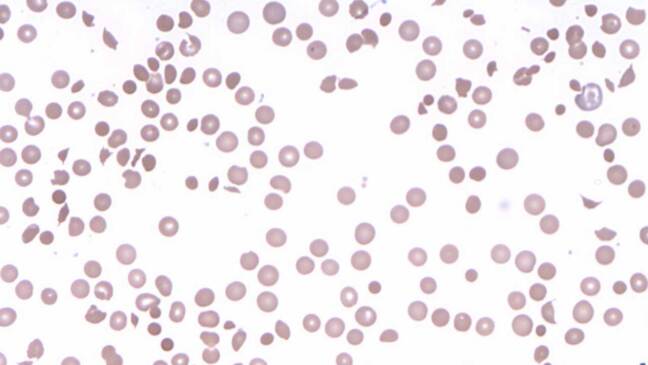 Peripheral Loop Rbc Drug-Induced Immune Hemolytic Anemia: Signs & Diagnosis