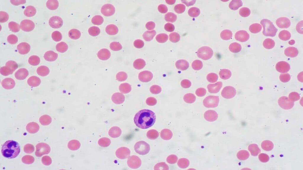 Presence of numerous spherocytes in the peripheral blood smear of a warm AIHA patient